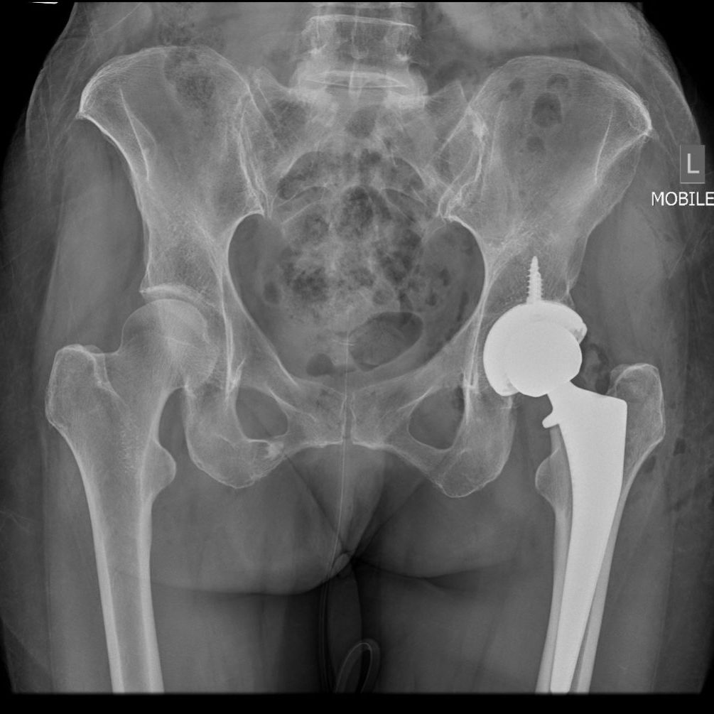 dr-terreblanche-services-page-treatments-section-total-hip-replacement