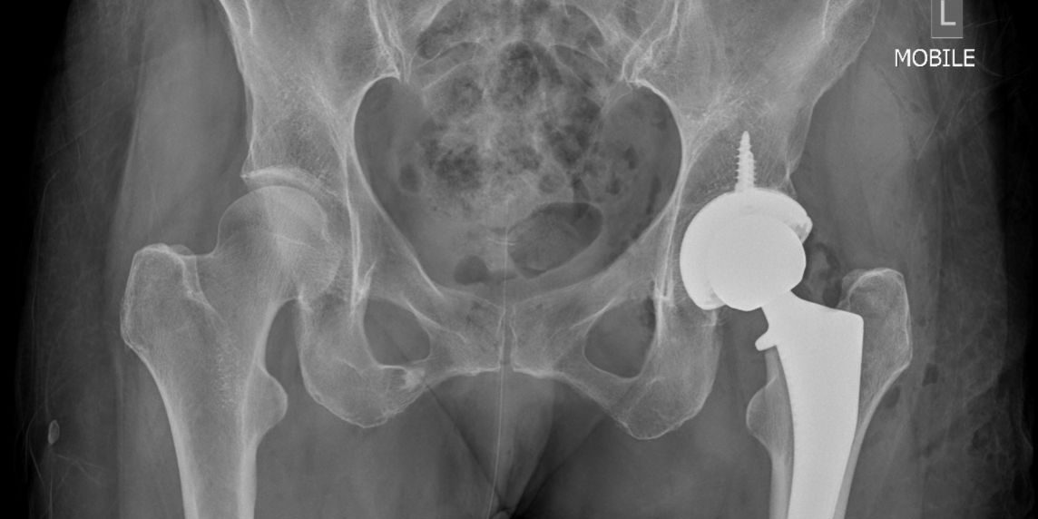 dr-terreblanche-services-page-treatments-section-total-hip-replacement